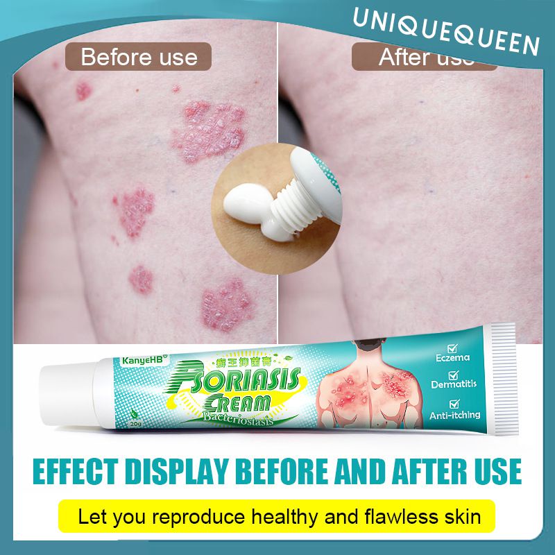 Psoriasis Eczema Anti Bacterial Skin Fungus Cream Skin Itching ...