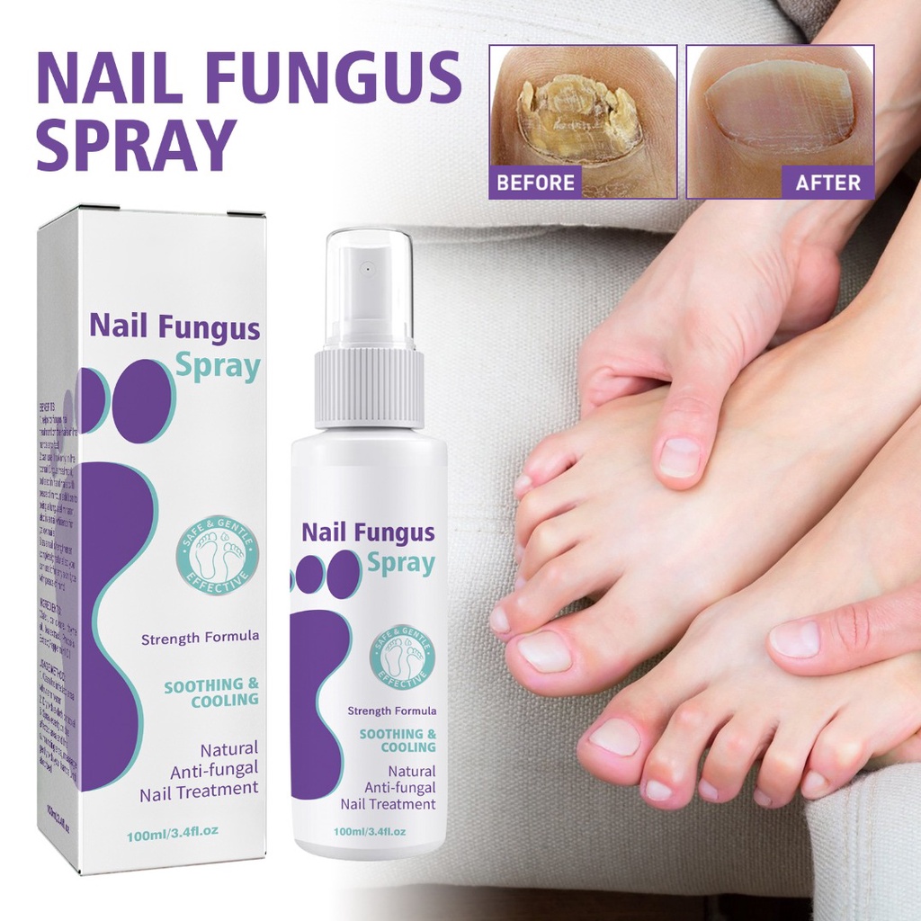 Nail Fungus Treatment Spray Anti-Fungal for Toenail Discolored Nails ...