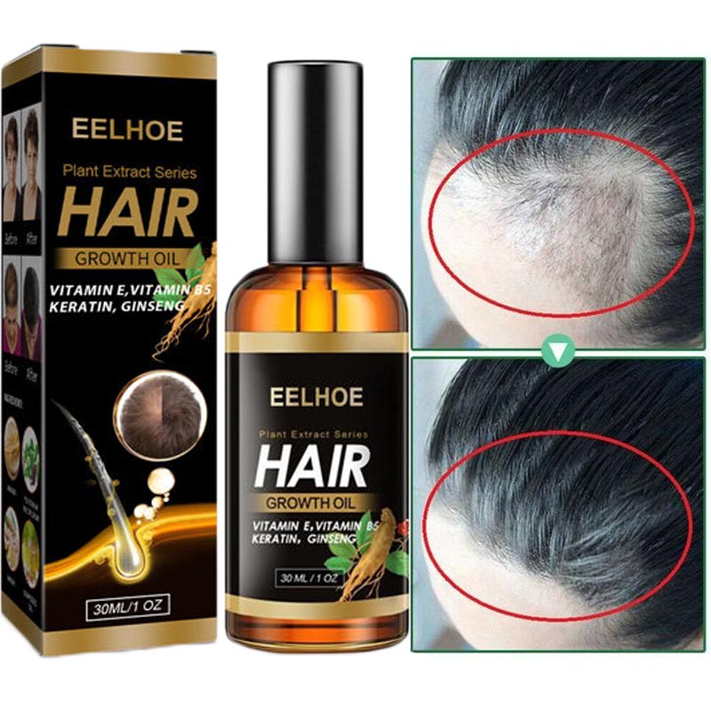 EELHOE Ginger Ginseng Hair Nutrient Solution Natural And Fast Treatment ...