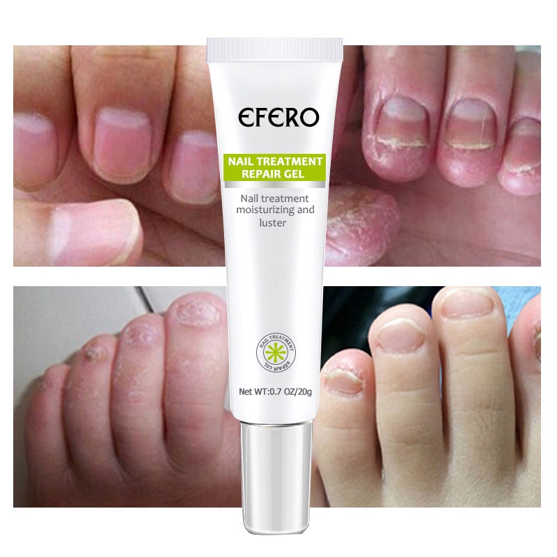 EFERO Nail Treatment Repair Gel 20g Nail Fungus Treatment Nail Repair Cream Nail Fungus Remover