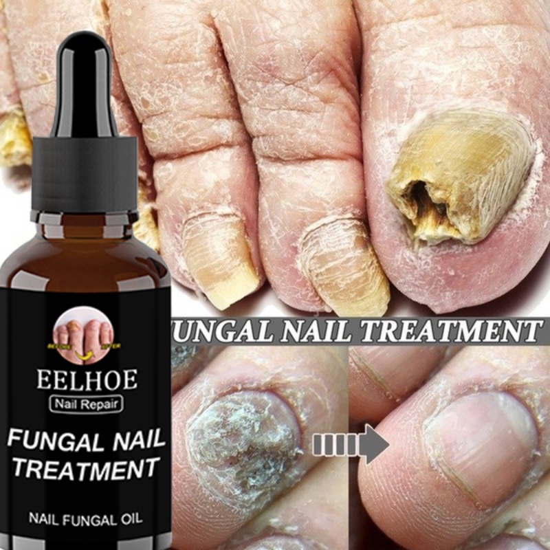 Nail care to get rid of folliculosis caused by fungus on fingers and