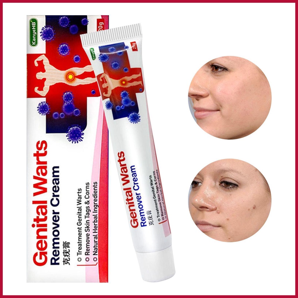 Face Wart Remover Safe Common Plantar Warts Remover 20g Wart Corn