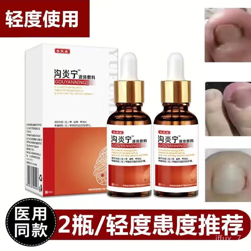 YQ30 Treatment of Paronychia Exclusive Use Fluid Ingrown Nail Removing