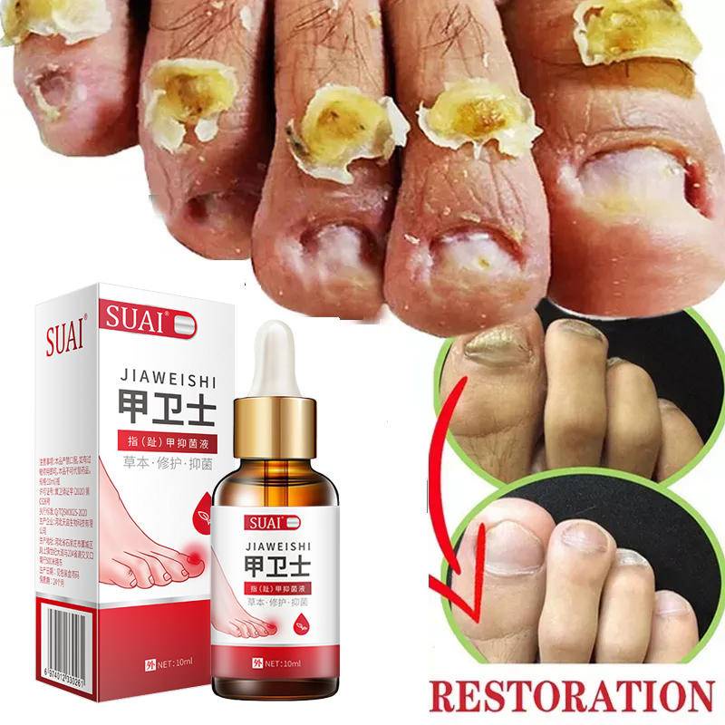 Suai Fungal Nail Treatment Oil Foot Repair Essence Toe Nail Fungus Removal Gel Anti Infection 2455