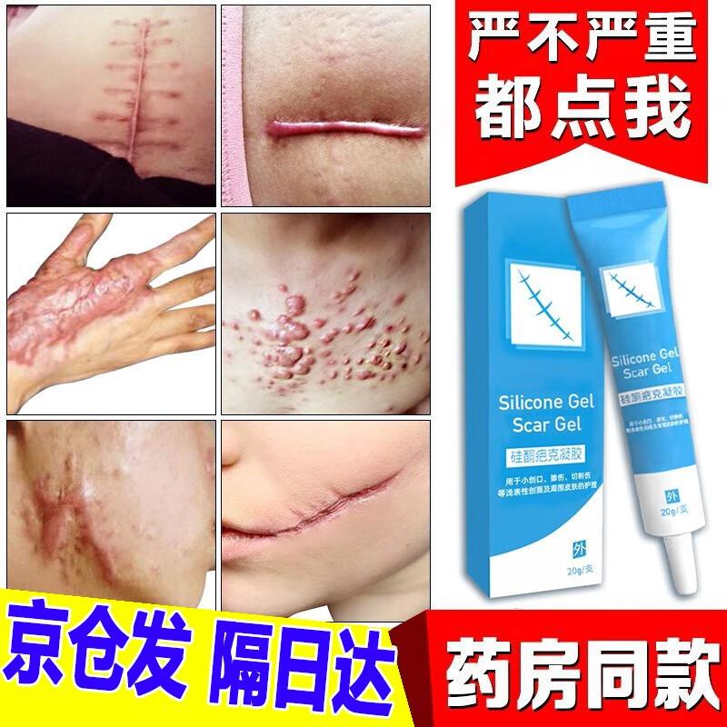 【祛新旧疤痕】疤克巴克祛疤膏疤痕灵去疤膏专用刀伤儿童脸部摔烫伤剖腹产双眼皮面部增生疤痕修复疤除膏痕药 【祛疤装】新疤 / 老疤 皆可用 ...