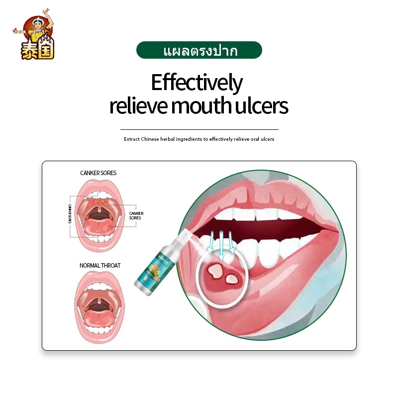 Mouth Ulcer Treatment Medicine Spray Antibaterial Oral Ulcers Relief ...