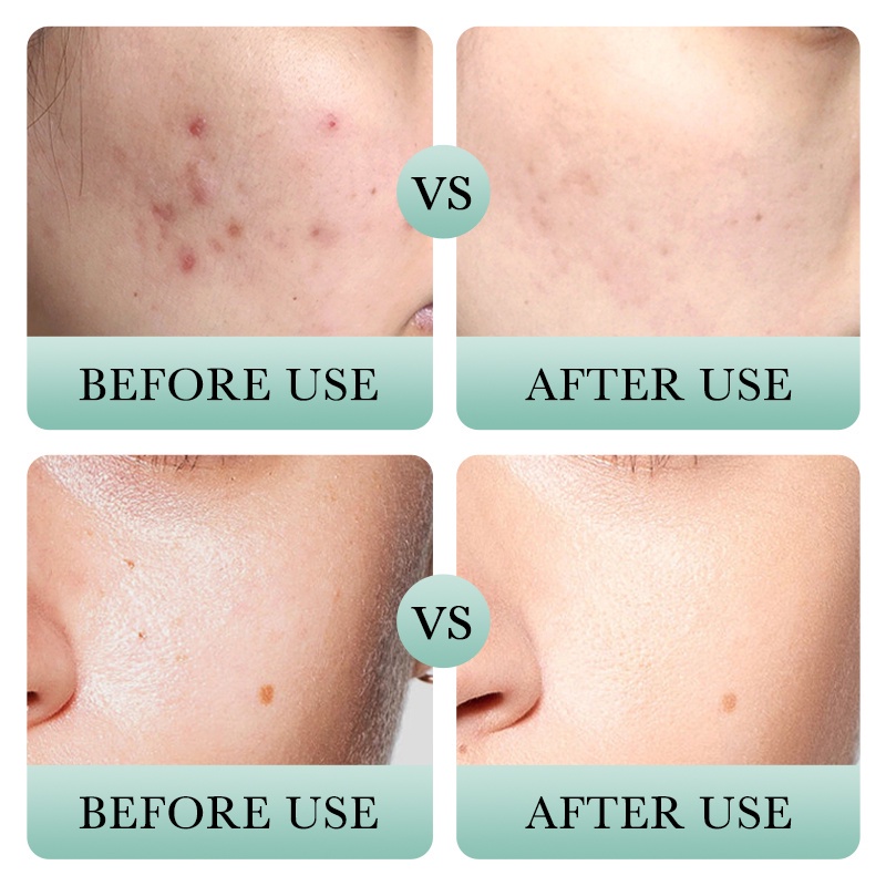 BIOAQUA Salicylic Acid Acne Removal Cleanser Moisturizing Oil Control Pore  Shrinking Facial Cleanser 100g | Shopee Singapore