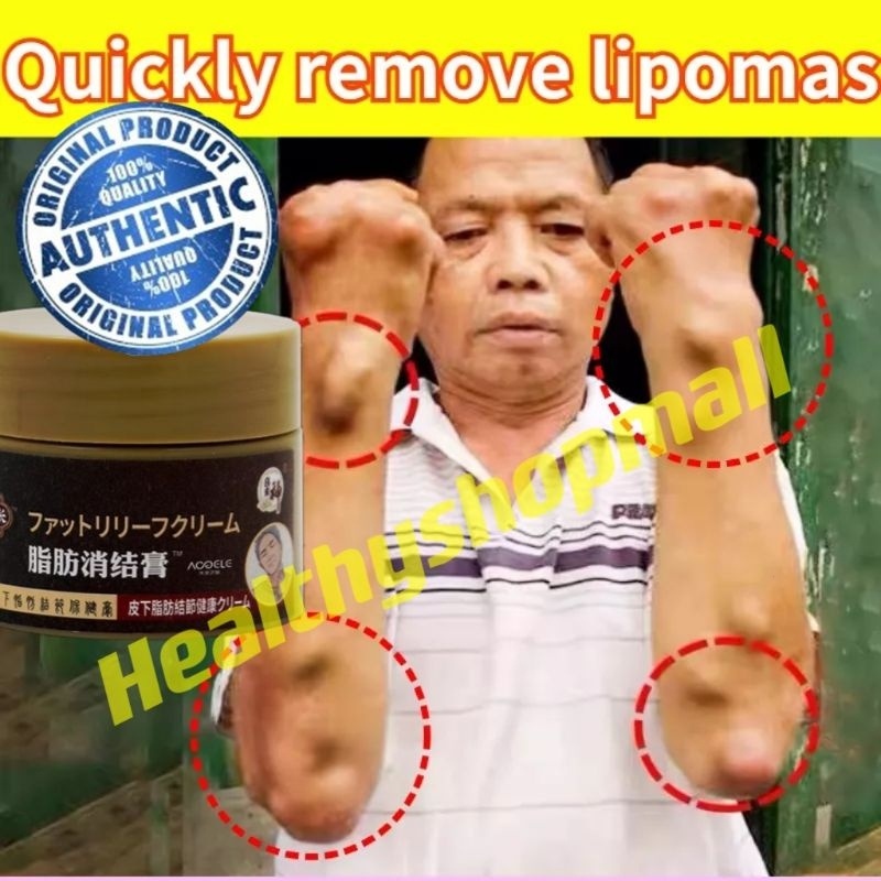 Lioma removal cream special gel for removing multiple single ...