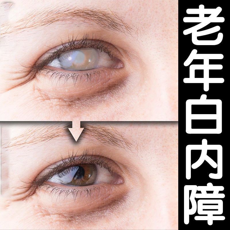 Cataract eye drops dry eye fatigue eye cloudy fuzzy ghosting White