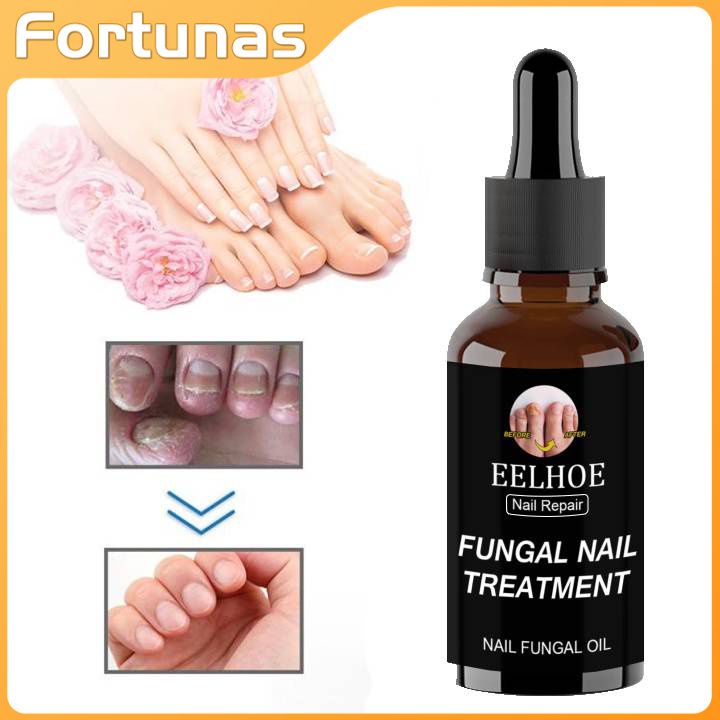Eelhoe Nail Fungus Repair Treatment Essence 50ml Fungal Paronychia Treatment Nail Treatment