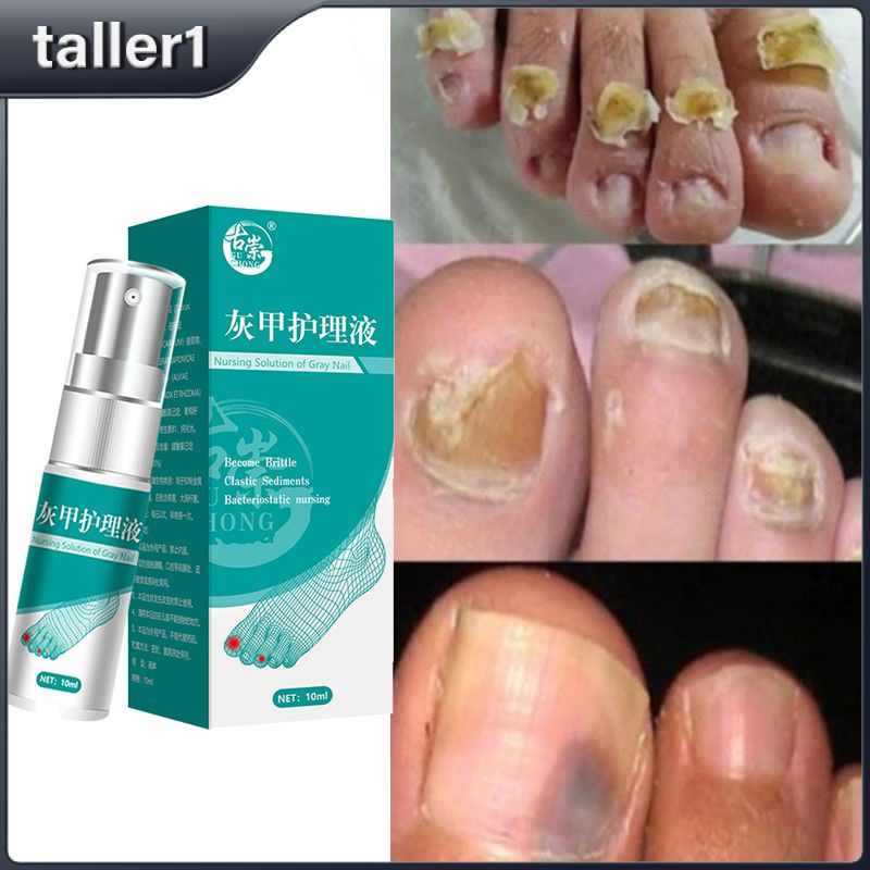 Nail Fungus Treatments Serum Spray Repair Toe Nail Fungal Removal