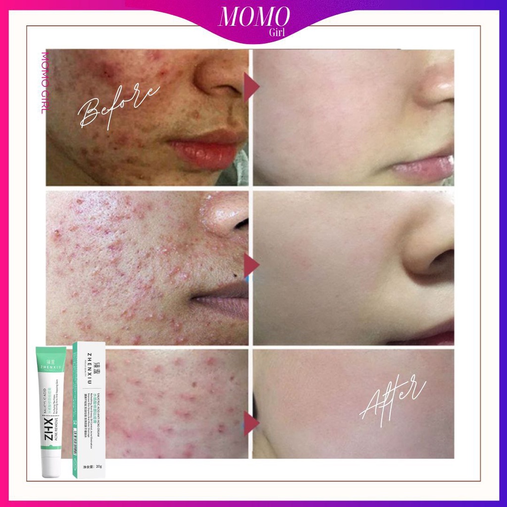 Acne Scars: Treatment and Removal - WebMD