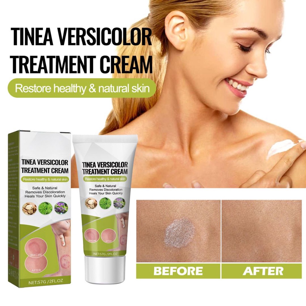 57g Tinea Versicolor Treatment Antifungal Cream for Tinea Versicolor ...