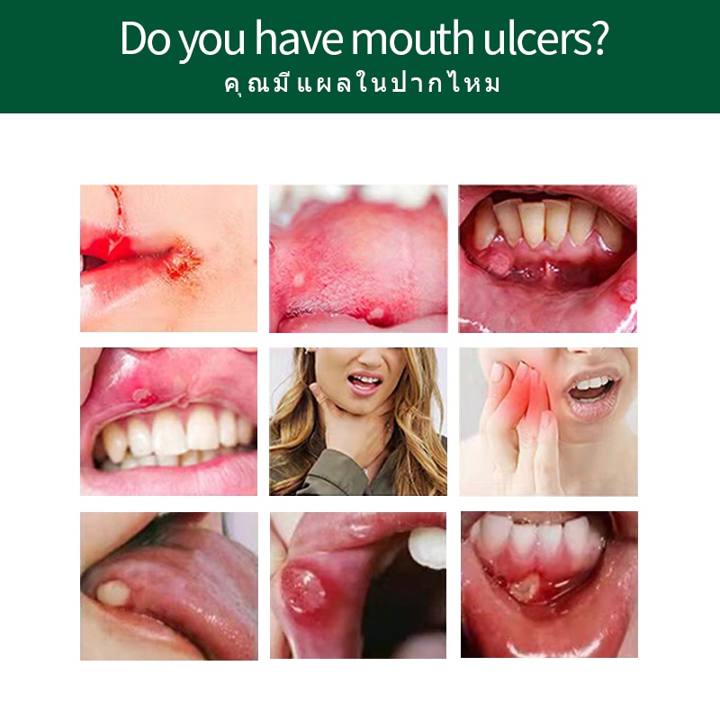 Mouth Ulcer Treatment Medicine Spray Antibaterial Oral Ulcers Relief ...