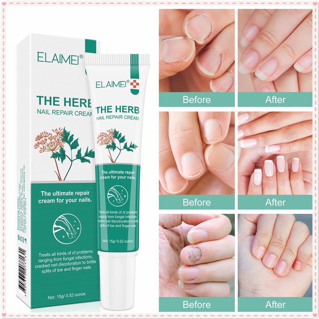 ELAIMEI Nail Care Cream AntiInfective Paronychia Onychomycosis Nail