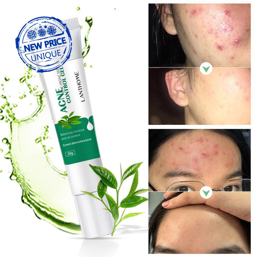 Pimple Scar Acne Mark Spots Removal Treatment Gel Ointment Blemish