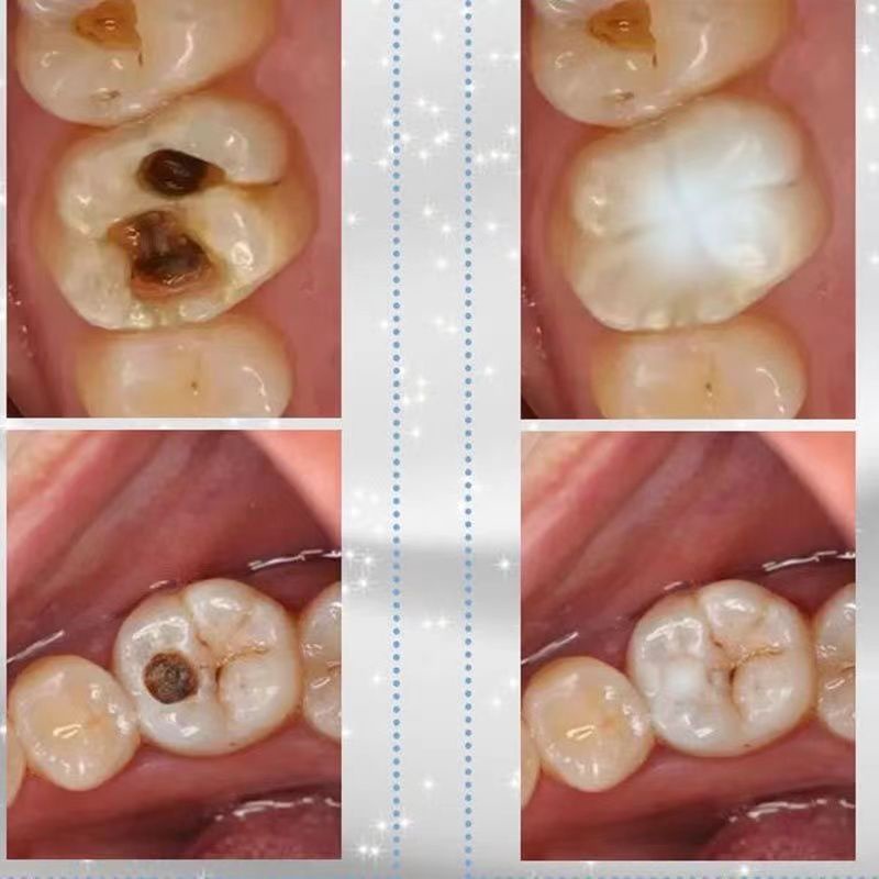 dental cavity filling toothpaste, fixing, toothpaste Too Shopee Singapore