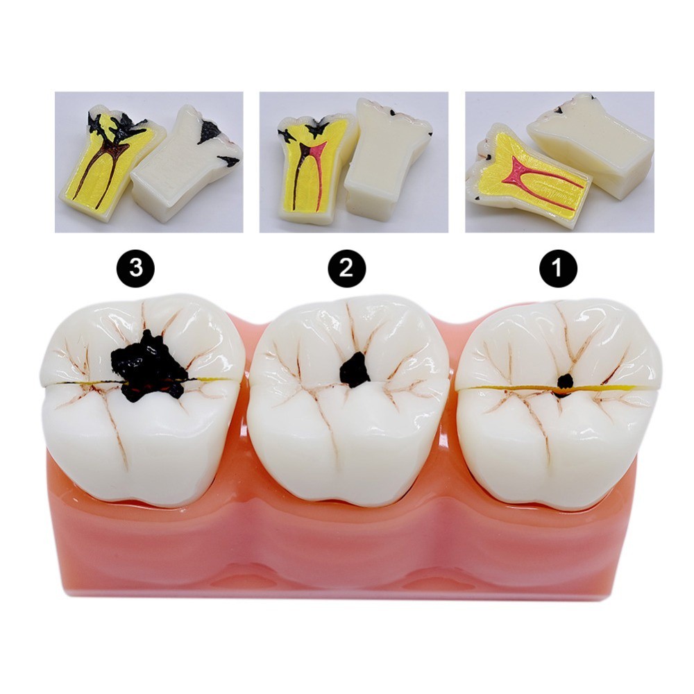 4 Times Dental Caries Model Caries Evolution Model Dental Model Tooth ...