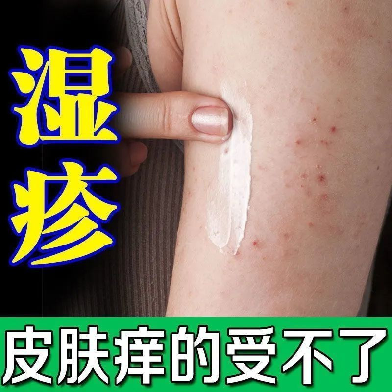 Calamine lotion eczema heat rash skin diseases and prickly heat rash ...
