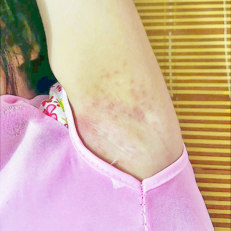 Armpit eczema, creaking, itchy red rash, small pimples in the ar Armpit ...