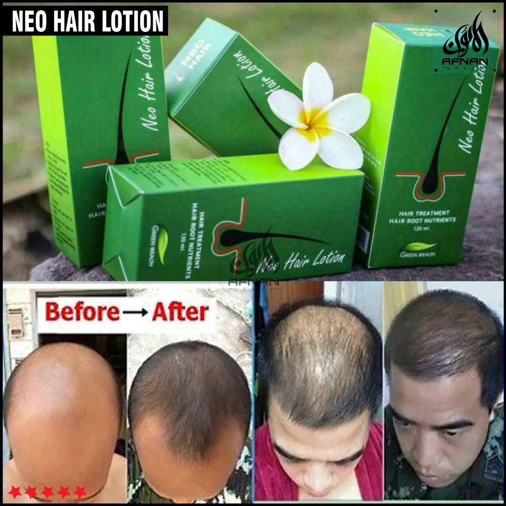 Neo Hair Lotion Anti Hair Loss Tonic Hair Treatment Solution 120ml Shopee Singapore 6355