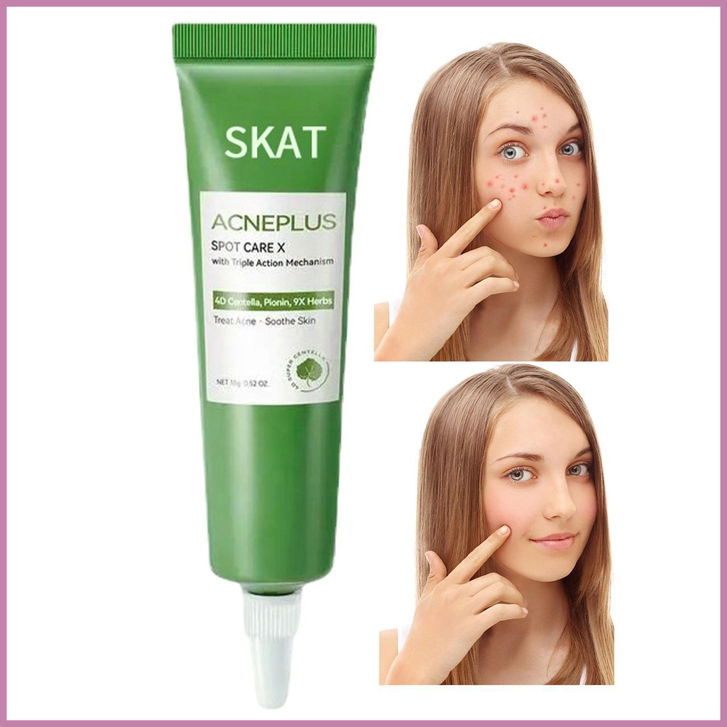 Pimple Remover Cream Natural Herbal Soothing Cream Herbal Pimple