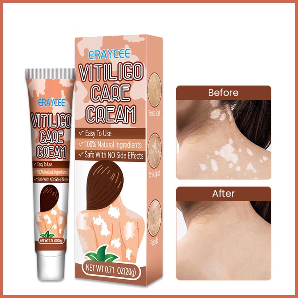 Skin Bleaching Cream for Vitiligo 20g Vitiligo Relief Cream for White
