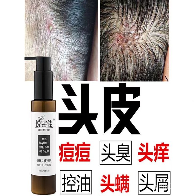 Scalp Folliculitis Red And Swollen Acne Anti Dandruff And Antiitchy Mite Shampoo Anti Dandruf