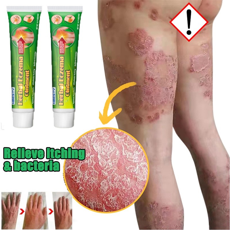 Itchy Skin Cream Itching of Inner Thigh AntiItch Psoriasis Eczema itch