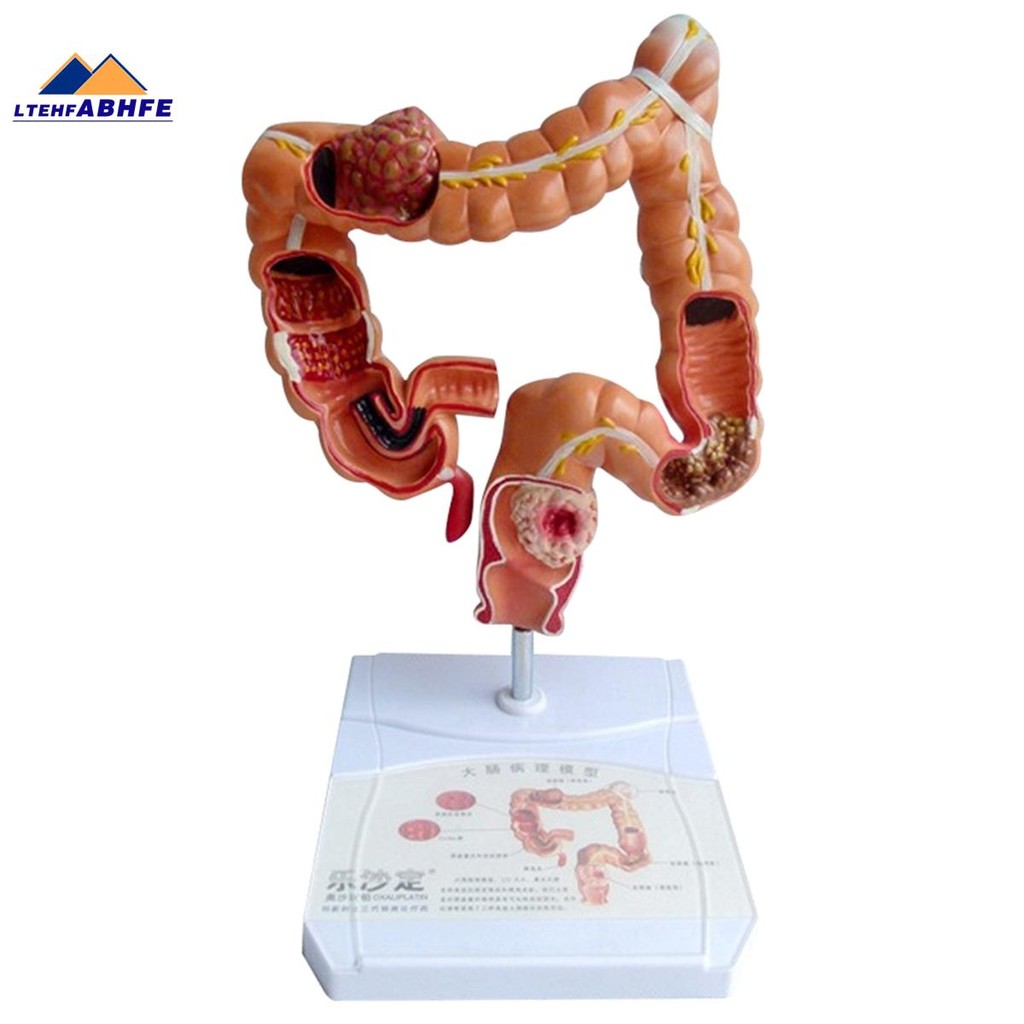 Teaching Model,Human Large Intestine Anatomy Model Visceral Lesion ...