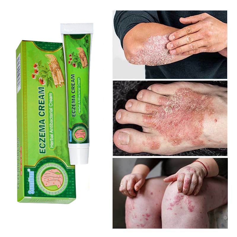 Eczema Cream Krim Psoriasis Cream Ubat Gatal Ketuat Krim Eczema ...