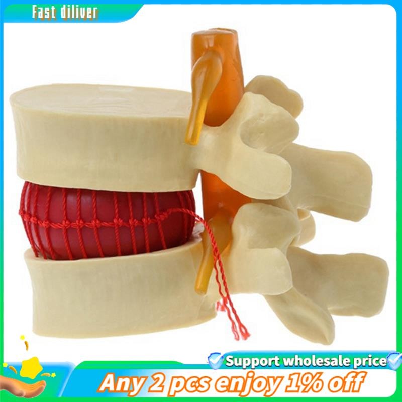 In stock-Lumbar Vertebrae Model Anatomical Spine Lumbar Disc Herniation ...