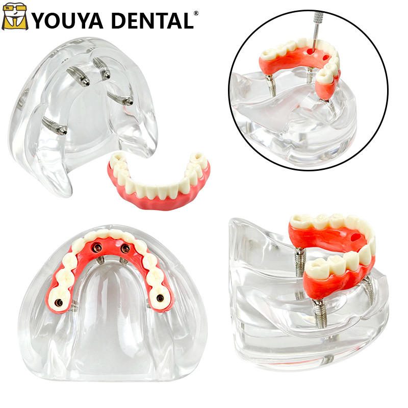 DSI Dental Low Lock Overdenture Attachment Kit - Straight Adapter Head, 0.5-6mm Heights, Israel Made