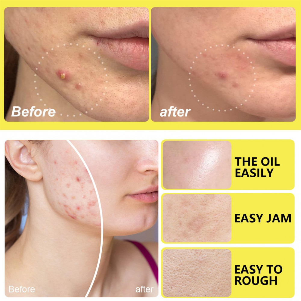 YL 5-in-1 Hydrocolloid Patches , Zit Stickers Pimple Patches ...