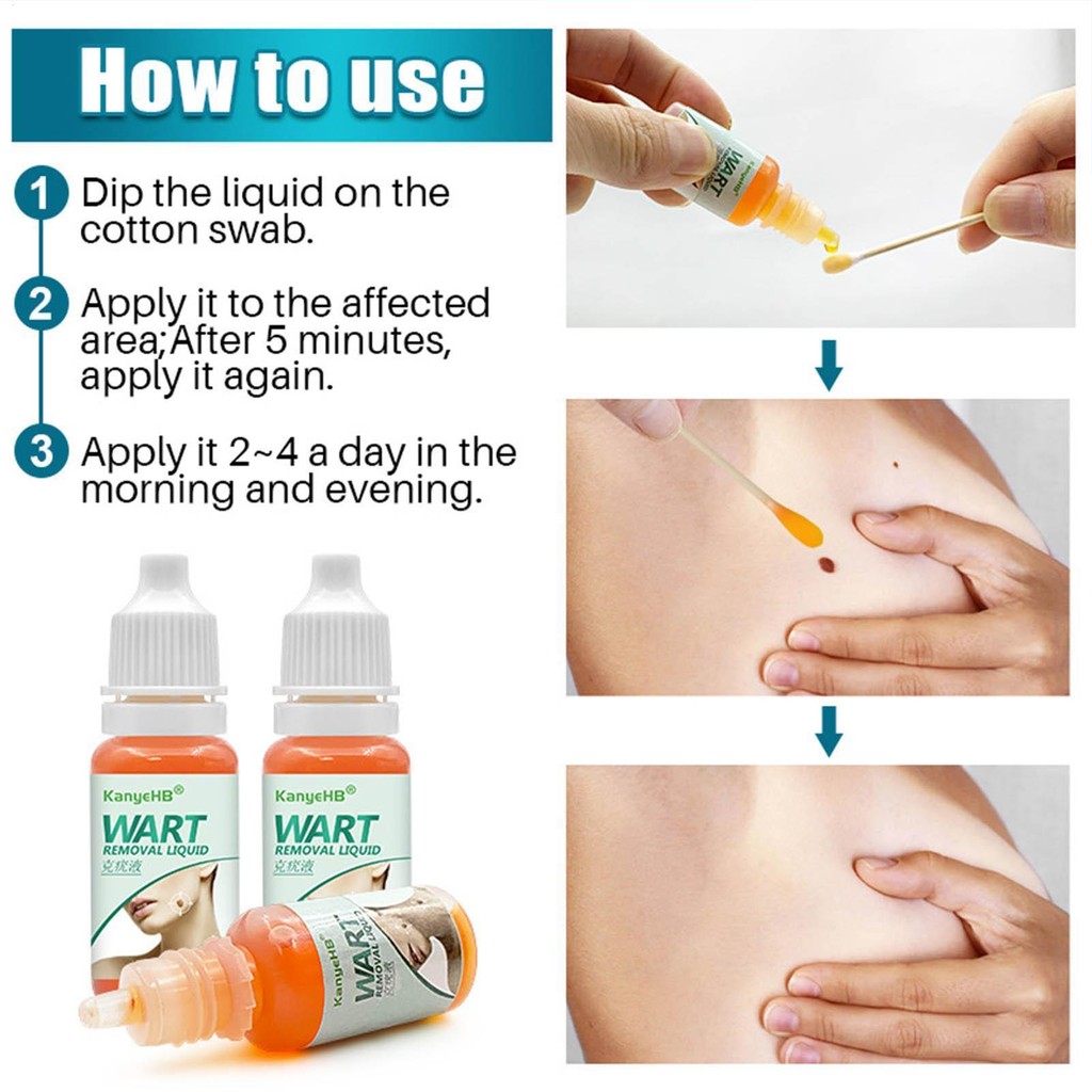 Wart Removal Liquid Common Genital Wart Remover Skin Tags Remover Flat ...