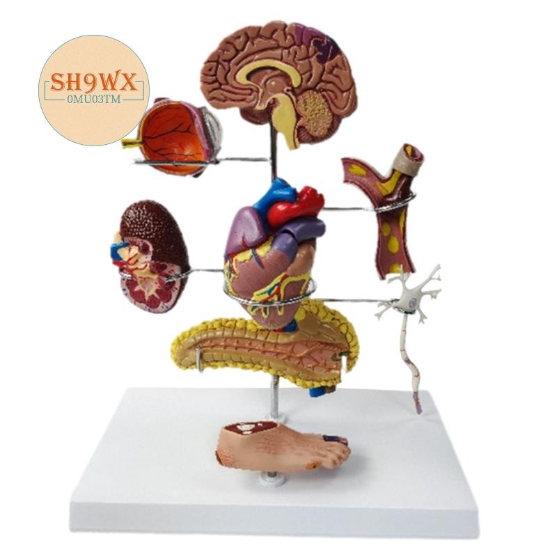 Type Ii Diabetes Model Set, for Human Anatomy and Physiology Education ...