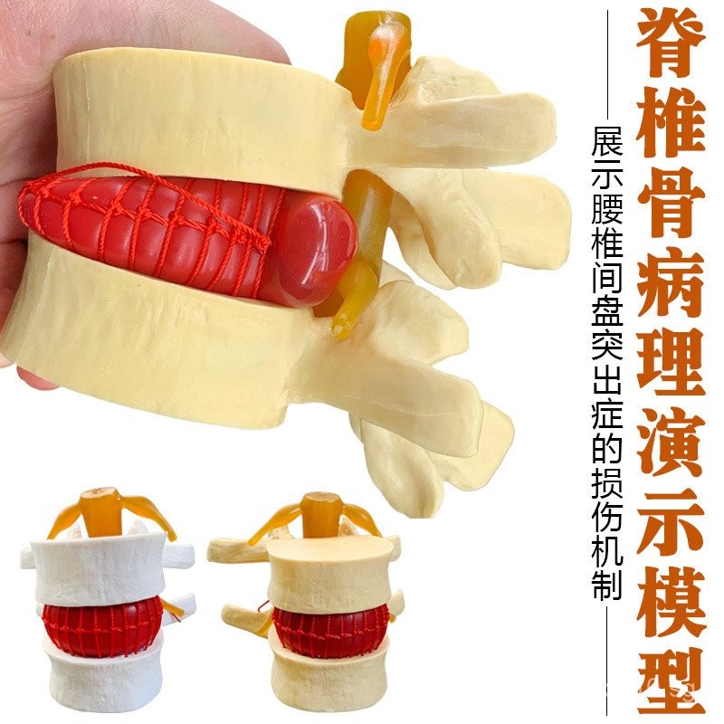 Lumbar Spine Compression Model Lumbar Disc Herniation Lumbar Disc ...