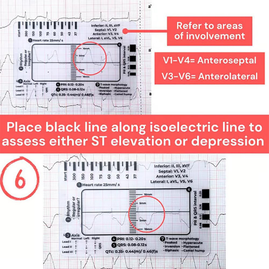 {downey} Plastic Ekg Ruler Id Badge Holder Ekg Ruler Pocket Ekg Ruler ...