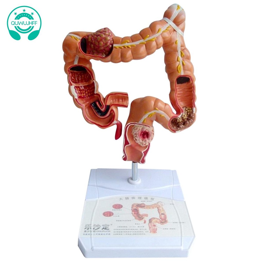 Teaching Model,Human Large Intestine Anatomy Model Visceral Lesion ...