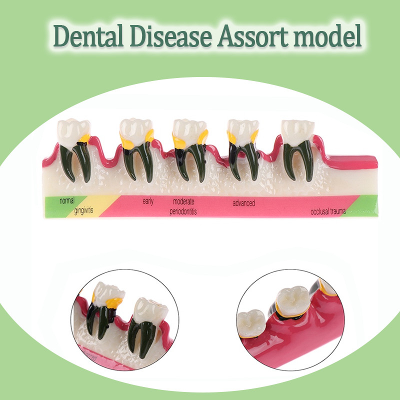 Dental Periodontal Disease Model Assort Demo Caries Model Dentist ...