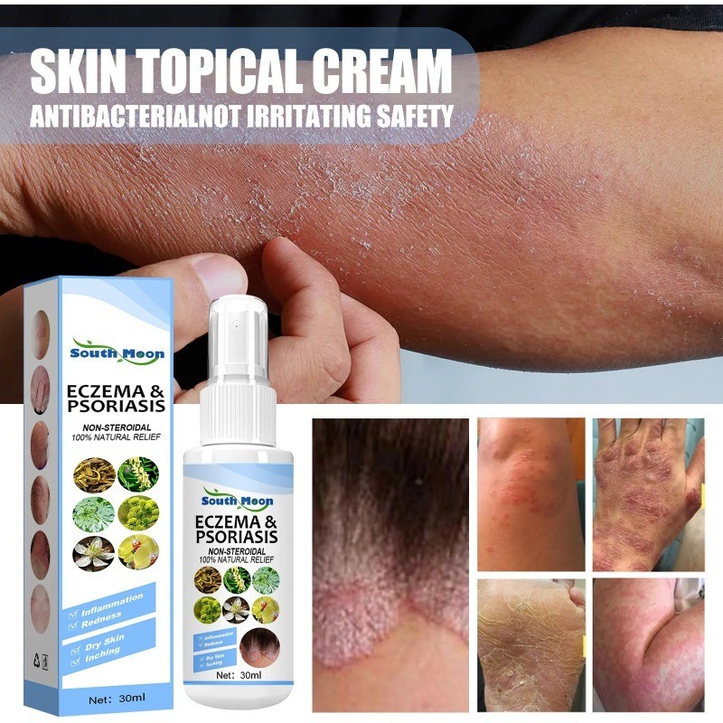 SouthMoon Skin Topical Spray Antibacterial Cream Eczema Psoriasis ...