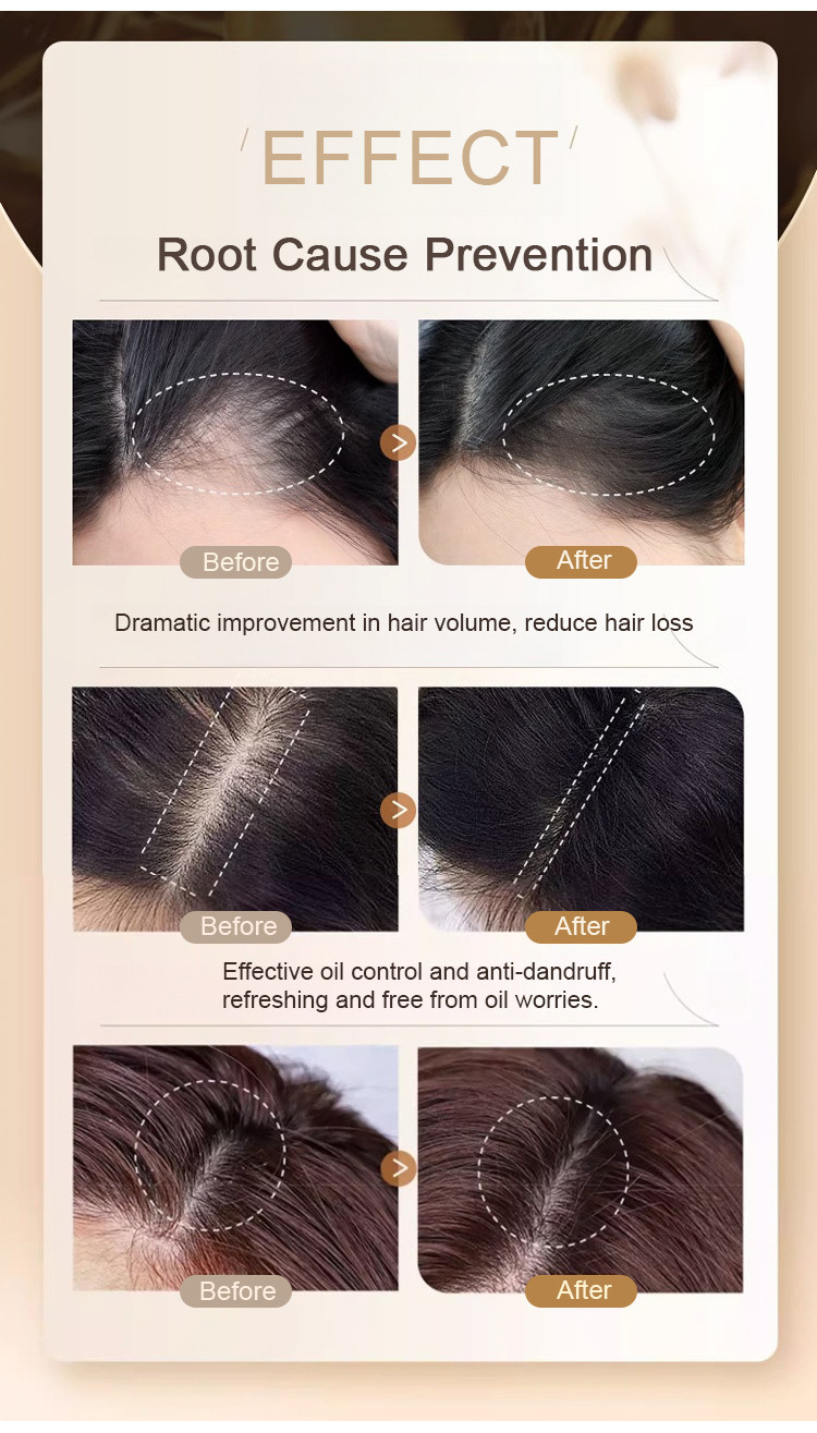 【Hot sale】[Strong hair roots]官方正品 Ginger Plant Extract Anti-Hair Loss ...