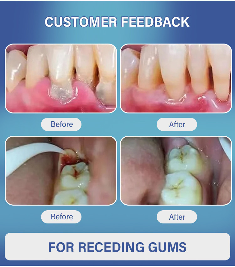 【Hot sale】[No need to pull out loose teeth]