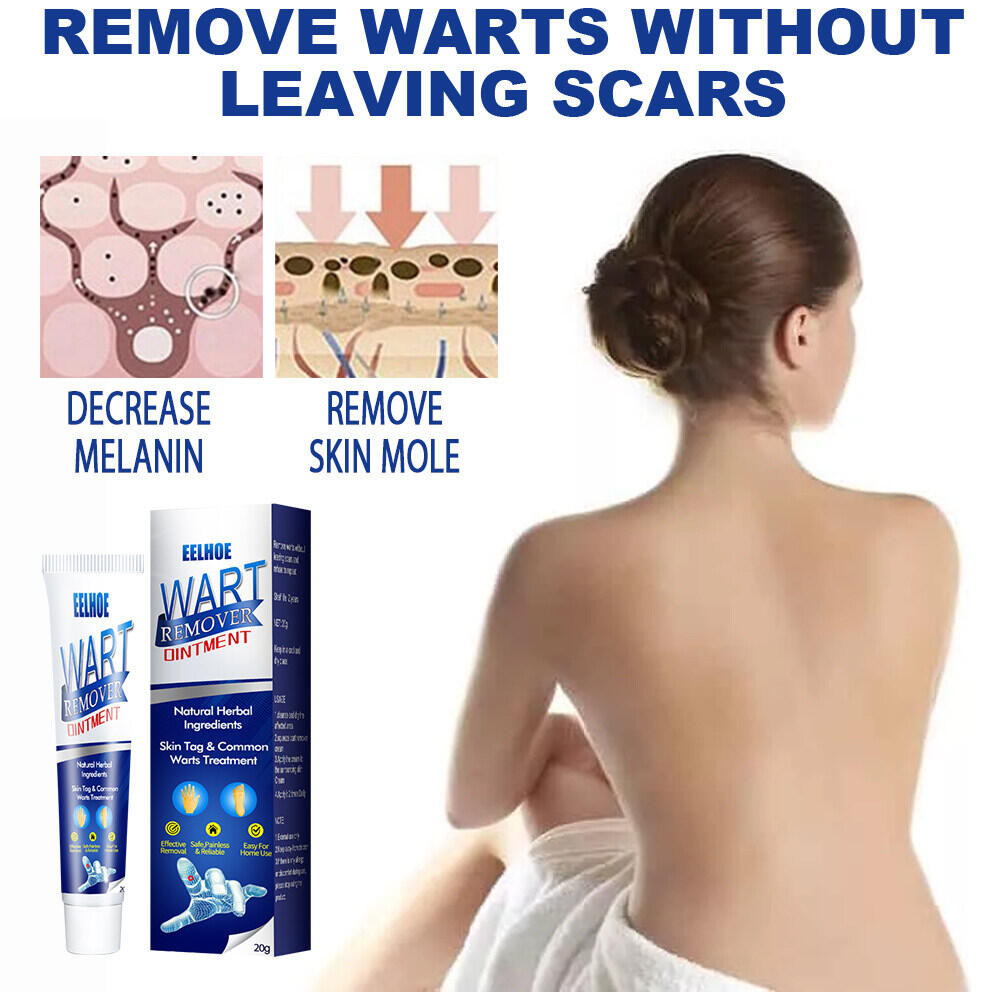 20g Warts Flat Eliminate Wart cream Wart Liquid Hand Foot Warts Remove ...
