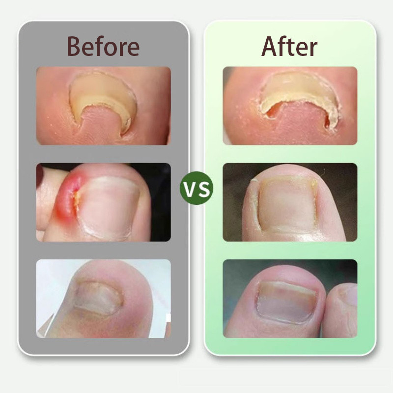 2/5Sheets Ingrown Toenail Corrective Stickers Foot Care Treatment ...