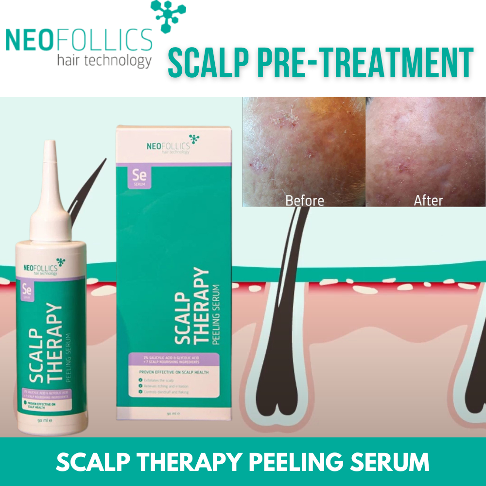 Neofollics Scalp Therapy Peeling Serum for Sebum buildup, Dead Skin