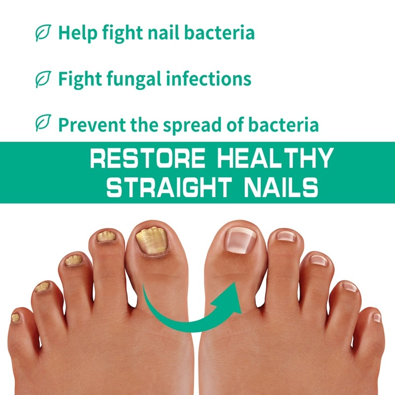 Nail Fungus Treatment Cream 20g_Fast Recovery Onychomycosis Paronychia Anti Infection Toe Fungal