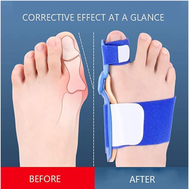 💞SG Stock💞Orthopedic Bunion Corrector Splint with Adjustable Hallux