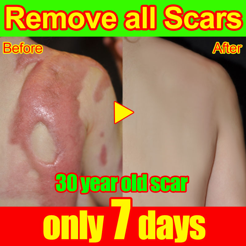 Scar Removal Cream Remove Caesarean Section Scars Stretch Marks