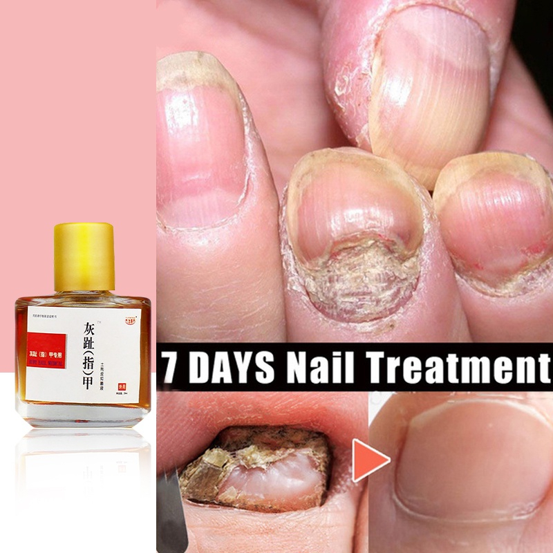 Nail Fungus Treatment Nail Repair Quick Repair Damaged Nails Anti
